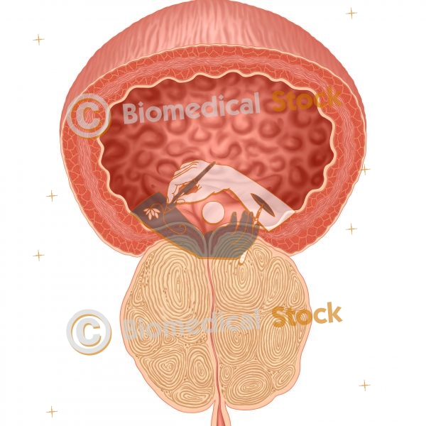 Benign prostatic hyperplasia (BPH) front view in full color